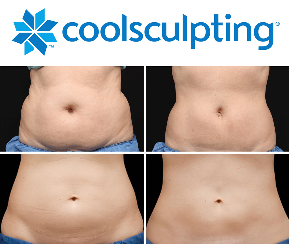 CoolSculpting body contouring treatment