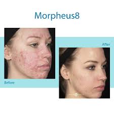 Morpheus8