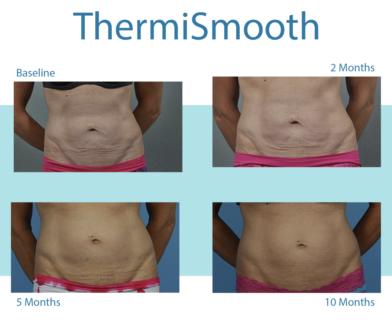ThermiSmooth 10-month stomach before and after