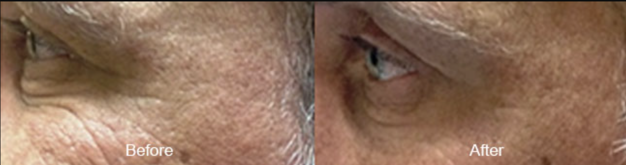 ThermiSmooth crow's feet before and after